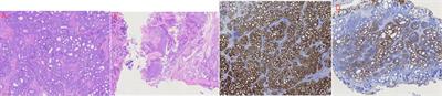 Basal cell carcinoma of the prostate with squamous metaplasia: A case report and literature review